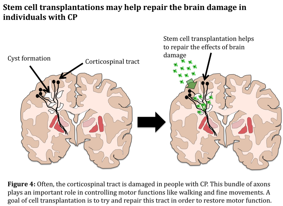 幹細胞投与により脳性麻痺による脳のダメージを修復している図